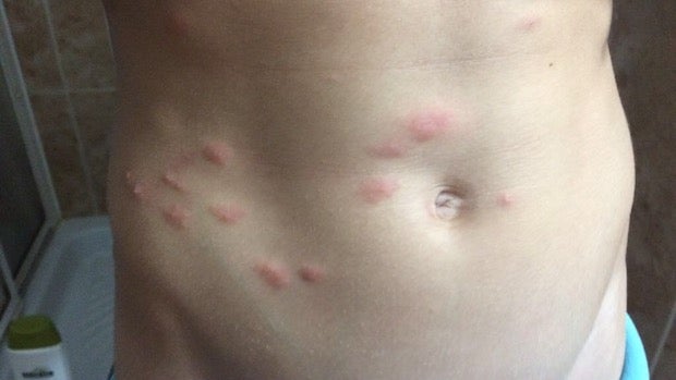 Torso del menor con las múltiples picaduras de pulga